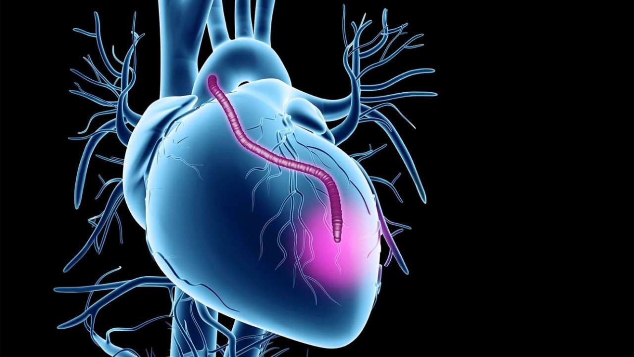 Racial Bias May Impact Access to Heart Transplants